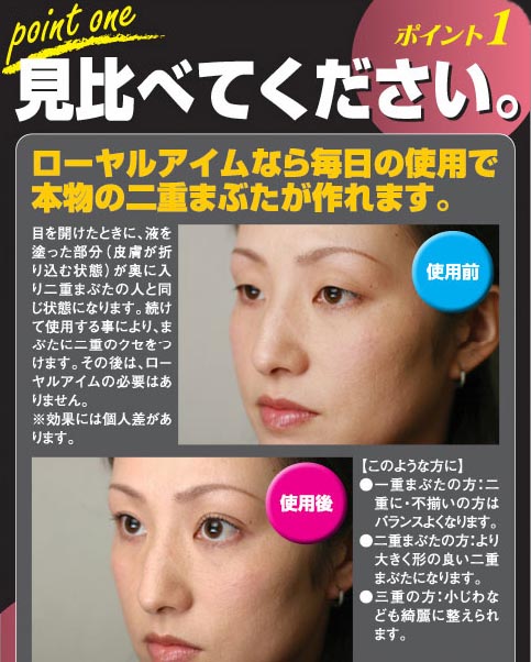 ローヤルアイムで二重まぶたに